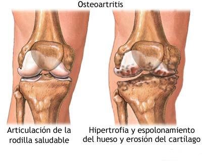 Problemas en las articulaciones osteoartritis que es